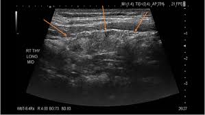 Hashimoto S Thyroiditis
