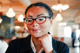 Vitiligo can be cosmetically very disabling, particularly in people with dark skin. Vitiligo Symptoms Causes And Treatments