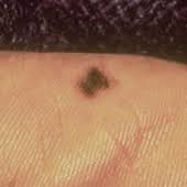 When alm begins in the nails, it may appear as a streak under the nail. Melanoma Warning Signs And Images The Skin Cancer Foundation