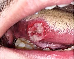 Image result for mouth ulcer on tongue)