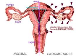 However, in rare cases it may also occur in other parts of the body. Endometriose Dz Algetriose Twitter