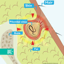 Helped over 8mm worldwide · 12mm+ questions answered Pilonidal Sinus Hair Bag Coccyx Fistula Symptoms Treatment Surgery