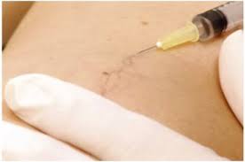 This helps decrease dilation of enlarged veins. Sclerotherapy For Spider Veins Inovia Vein Specialty Centers