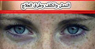 الفرق بين الكلف والنمش وكيفية إزالتهما In 2021 Cle