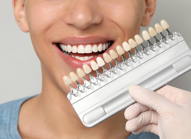 Dental Veneers Braces