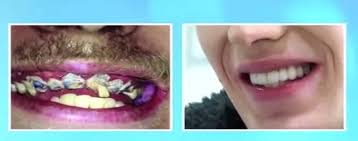 If brushing isn't an option immediately after a meal, then rinse your. This Guy Hasn T Brushed His Teeth For 20 Years And Omg It S Shocking