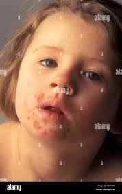 Image result for yellow scabs on the face in children