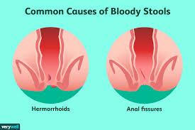 Image result for blood in stool human poop