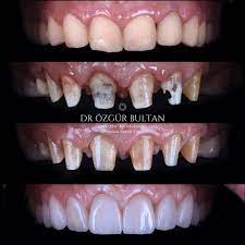 Replacement Of Existing Restorations With The Ips E Max Press Crowns Intracoronal Bleaching Sodium Parboratedistilled Wat Happy Dental Dental Cavities Dental