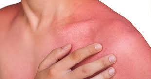 Having allergies can be difficult to manage. Heat Rash Sun Rash What S The Difference Osf Healthcare