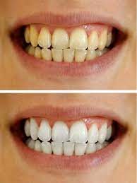 We did not find results for: Teeth Whitening Smile Specialties