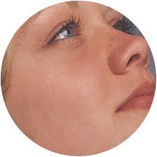 Glogau Wrinkle Scale