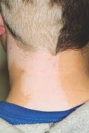 These make up your natural hair and skin color. What Is This Long Standing Loss Of Pigment Clinician Reviews