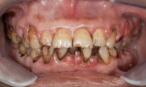 Image result for gums cancer symptoms