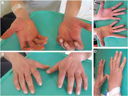 • период восстановления (от нескольких недель до нескольких лет). Bilateral Claw Hand An Uncommon Presentation Of Regional Guillain Barre Syndrome Journal Of The Neurological Sciences