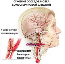 Pochemu Vysokoe Nizhnee Arterialnoe Davlenie Chto Delat Gbuz Pk Gajnskaya Crb