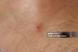 Image result for Fly Bite