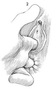 Image result for Bartholin's gland abscess