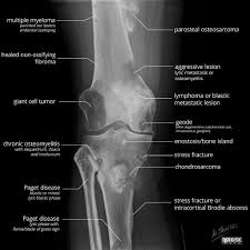 Benign bone tumors are noncancerous growths in or on bones. Bone Lesion Differential Diagnosis Illustrations Radiology Case Radiopaedia Org