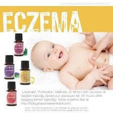 This oil can be used to lessen the irritation that skin deals with when someone has eczema. Baby Steps To Essential Oils Eczema Recommendation Essential Oils For Babies Essential Oils For Eczema Living Essentials Oils