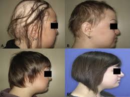 It does irritate the scalp. Efficacy And Safety Of Diphenylcyclopropenone Alone Or In Combination With Anthralin In The Treatment Of Chronic Extensive Alopecia Areata A Retrospective Case Series Sciencedirect