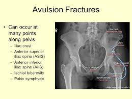 In adults, the ligaments and tendons tend to be injured first, whereas in children the bone may fail before. Injuries To Pelvis And Hip Ppt Download