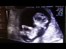 A nuchal scan or nuchal translucency (nt) scan/procedure is a sonographic prenatal screening scan to detect cardiovascular abnormalities in a fetus, though assessment of the dating of the pregnancy. Ultrasound Scans During Pregnancy Kjk Hospital Trivandrum