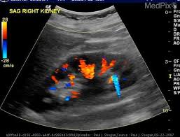 Medpix Case Nephrolithiasis With Twinkle Artifact On Color Dopler Ultrasound Unique to kidney stone removal under the inﬂuence of. nephrolithiasis with twinkle artifact