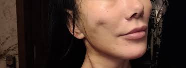 Face-lift & Neck-lift Support Group