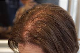 Luxury european human hair toppers with clips > silk base > style: As They Age Women Lose Their Hair Too Which Treatments Really Work