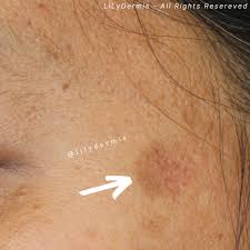 Image result for Solar Lentigo