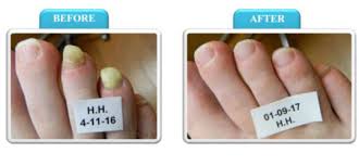 anti fungal toenail laser treatment