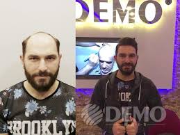 Www Demohair Com Protez Sac Modelleri Turkiye Istanbul 0212 224 05 80 Sac Istanbul