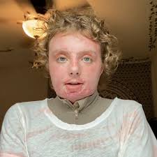 This girl is about to open up about her shocking burn survivor story 😪