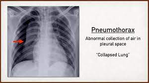 The air accumulation can apply pressure on the lung and make it collapse. Pt Trick For Pneumothorax Types Symptoms Risk Factors Causes And Treatment Of Collapsed Lung Ezmed