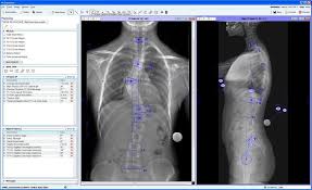 5790 locuințe au fost procurate prin intermediul programului guvernamental prima casă. It S A Power Punch Of 2d 3d Surgical Planning Products As Materialise Acquires Orthoview 3dprint Com The Voice Of 3d Printing Additive Manufacturing