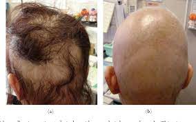 Our results support a previously proposed model of alopecia areata in which immunity is. Pdf Severe Hair Loss Of The Scalp Due To A Hair Dye Containing Para Phenylenediamine Semantic Scholar