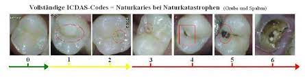 This study aims to study caries and the associations of the number of caries lesions between the permanent and primary molars with. Internationales Karieserkennungs Und Beurteilungssystem Icdas Ii