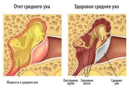 Bol I Zalozhennost V Ushah Chto Delat O Chem Govoryat Simptomy Diagnostika I Lechenie Lor Boleznej