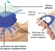 El cierre de la pared abdominal y torácica: La cenicienta en ...
