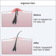 The ingrown concentrate, including tea tree oil and coconut oil, is then meant to be used on ingrown hairs that have already sprouted or on sensitive skin daily to prevent bumps. How To Get Rid Of An Infected Ingrown Hair
