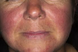 Lupus is a chronic autoimmune disease that can affect just about any organ or body part. Uncommon Mimickers Of Systemic Lupus Erythematosus Rheumatology Advisor