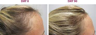 Like testosterone, both sexes have these hormones in their bodies. 1 Hair Growth Products For Women Viviscal