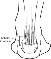 With aging and overuse, the achilles tendon is subject to degeneration within the substance of the tendon. Achilles Tendon Disorders Foot Health Facts
