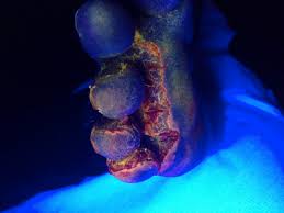 Image result for Erythrasma