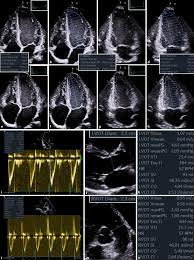Myocarditis is an inflammation of the heart muscle (myocardium). Manual Zur Indikation Und Durchfuhrung Der Echokardiographie Update 2020 Der Deutschen Gesellschaft Fur Kardiologie Springerlink
