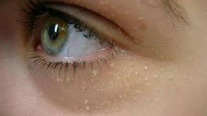 Atau mungkin memiliki biji kolesterol di kawasan hidung, mata, leher, atau di muka? Cara Ampuh Hilangkan Bintil Di Kulit Wajah Dengan Cepat Citizen6 Liputan6 Com
