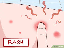 Outside of healthcare settings in the community (where you live, work, shop, and go to school), mrsa most often causes skin infections. Symptome Einer Mrsa Infektion Erkennen 13 Schritte Mit Bildern Wikihow