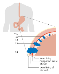 Stomach cancer most commonly begins in the cells that line the inside of the stomach. Stomach Cancer Wikipedia
