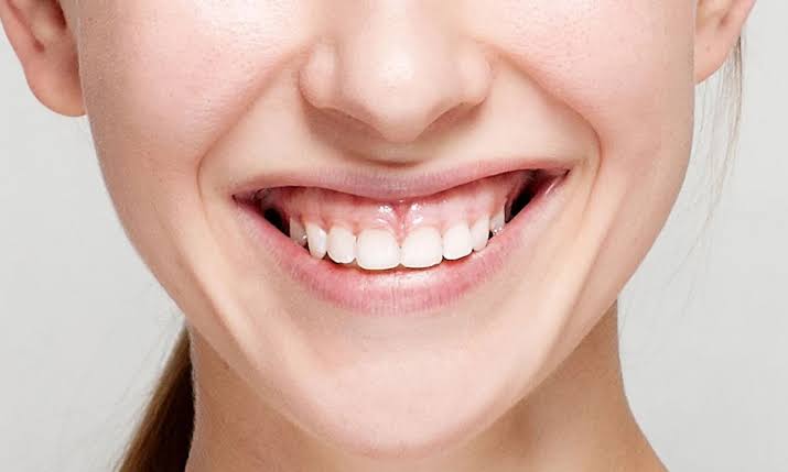 لبخند لثه ای